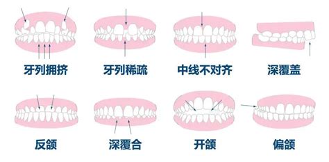 上排牙齒蓋住下排牙齒|介紹理想的咬合關係，整齊的牙齒排列應該是什麼樣。